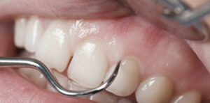 Scopri di più sull'articolo CHIRURGIA PLASTICA MUCOGENGIVALE