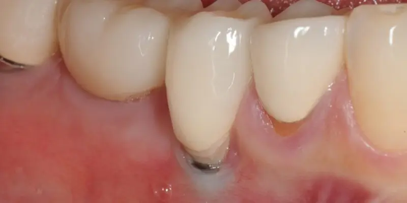 Peri implantite