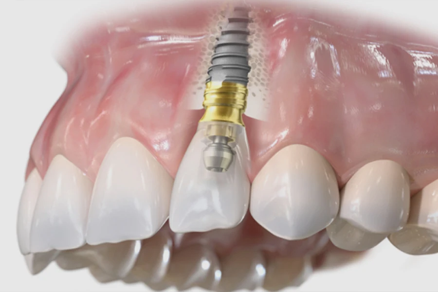 servizio implantologia dentale