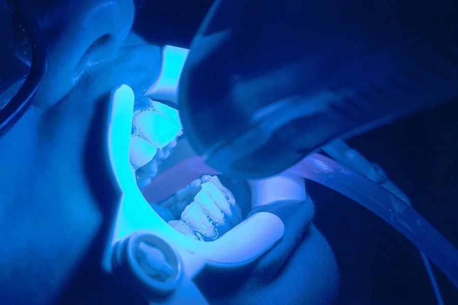 sbiancamento led dentale