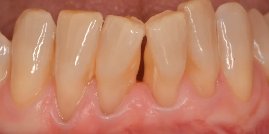 parodontite cura con il laser